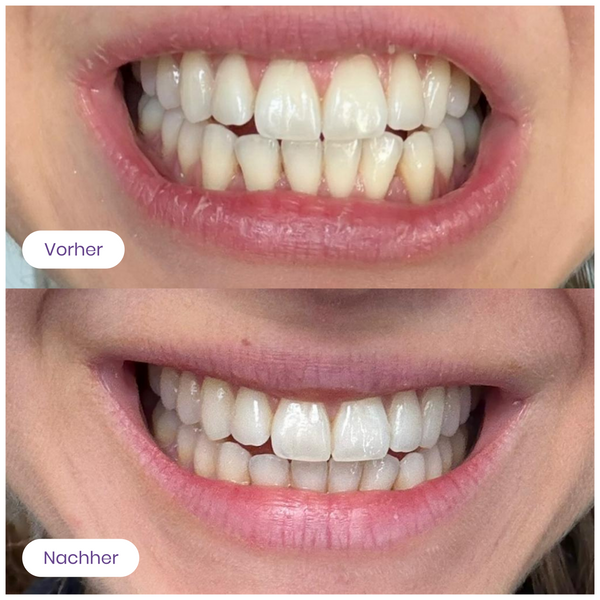 Soft White Zahngel - Vorbestellung